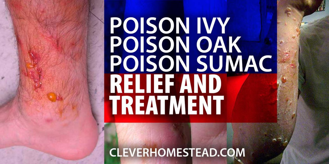 Poison ivy, poison oak and poison sumac RELIEF, TREATMENT and HEALING
